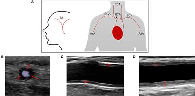 The Diagnostic Performance of an Extended Ultrasound Protocol in Patients With Clinically Suspected Giant Cell Arteritis